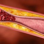 Αθηροσκλήρυνση Αγγείων